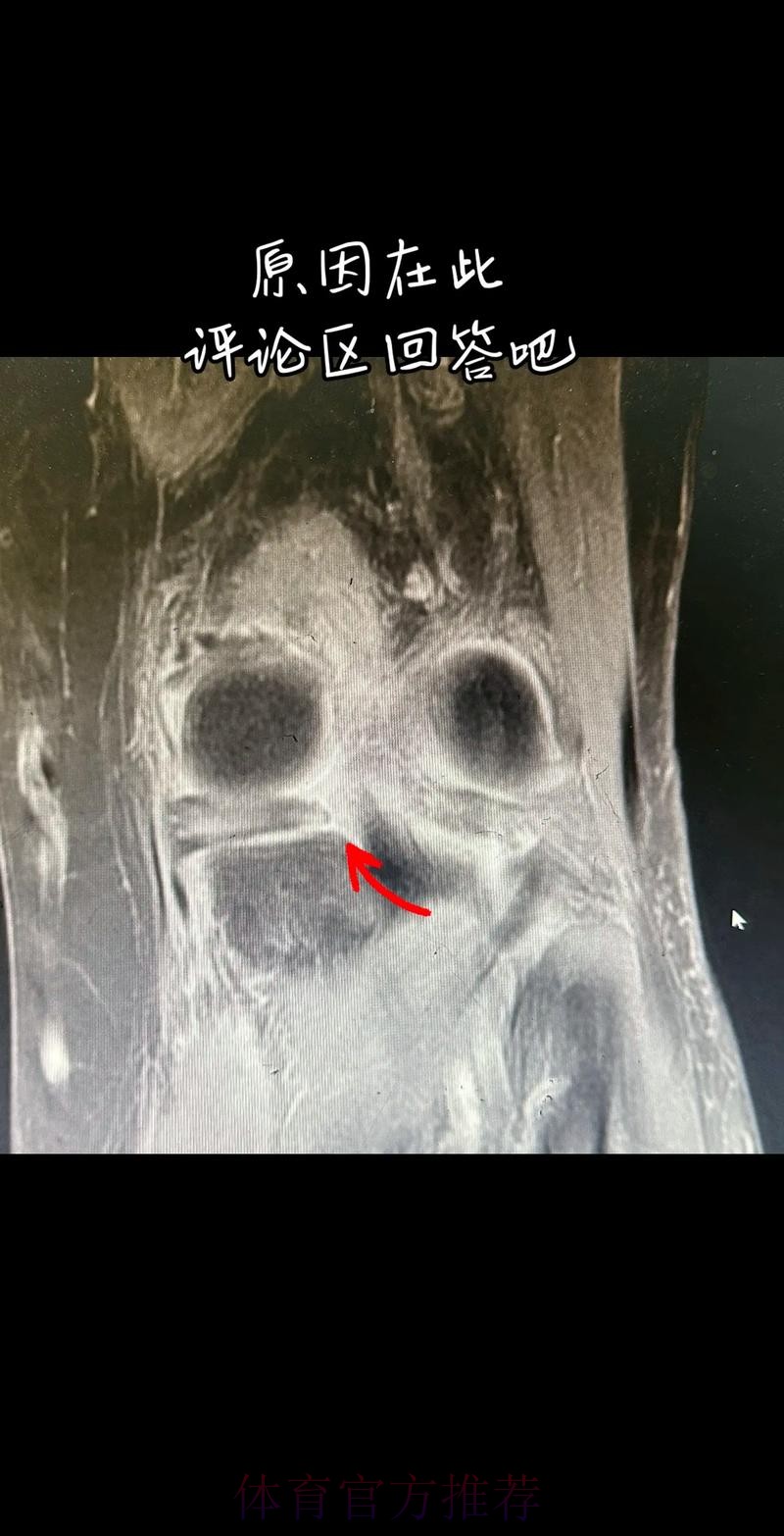 官方:阿拉巴左膝内侧半月板撕裂 预计伤缺6-8周 官方:阿拉巴左膝内侧半月板撕裂 预计伤缺6-8周