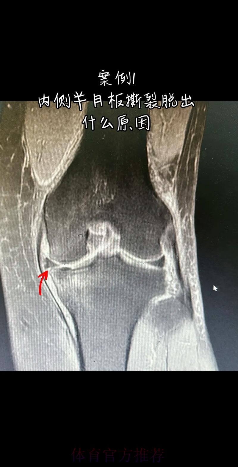 官方:阿拉巴左膝内侧半月板撕裂 预计伤缺6-8周 官方:阿拉巴左膝内侧半月板撕裂 预计伤缺6-8周